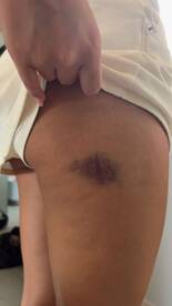 An unclear image showing a close-up of a bruise on a person's thigh, with a hand touching the area. The context of the image is ambiguous.